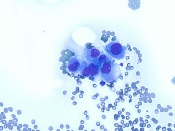 Lung mass FNA today Please join in the discussion图5