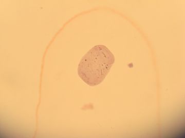 尿液细胞学涂片：什么东西？图2