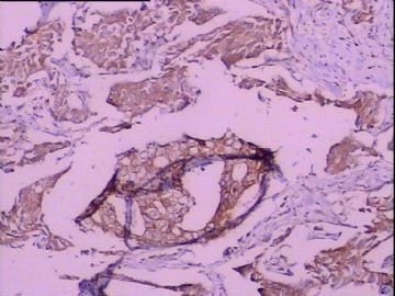 C-erbB-2免疫组化检测图3