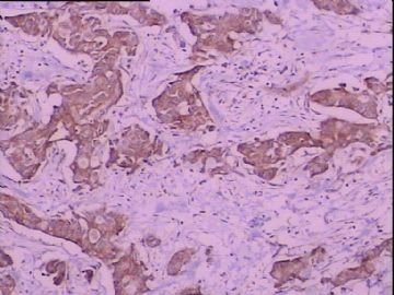 C-erbB-2免疫组化检测图5