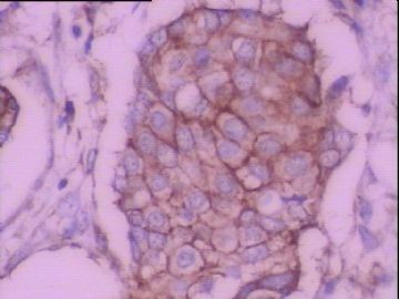 C-erbB-2免疫组化检测图7