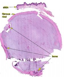 （ZT）足部皮下软组织肿瘤图1