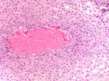 Breast lobular lesions and stains ( cqz 7)图4