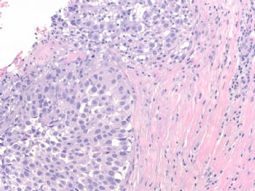 Breast lobular lesions and stains ( cqz 7)图5