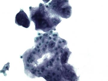FNA of chest wall nodule图3