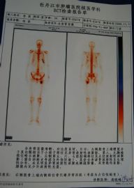 股骨粗隆肿物图5