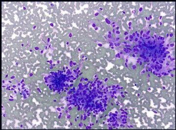 Neck 副节瘤 (paraganglioma )FNA and its differential diagnosis  (cqz 3)图1