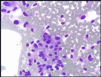 Neck 副节瘤 (paraganglioma )FNA and its differential diagnosis  (cqz 3)图2