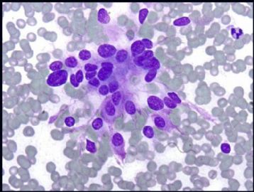 Neck 副节瘤 (paraganglioma )FNA and its differential diagnosis  (cqz 3)图3