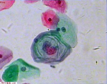 33岁，宫颈光滑，液基制片。图7