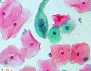 33岁，宫颈光滑，液基制片。图8