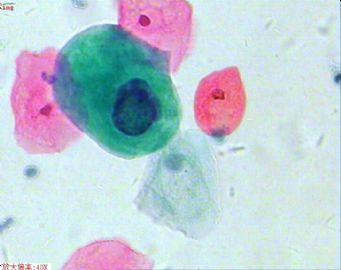 33岁，宫颈光滑，液基制片。图9