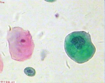 33岁，宫颈光滑，液基制片。图10