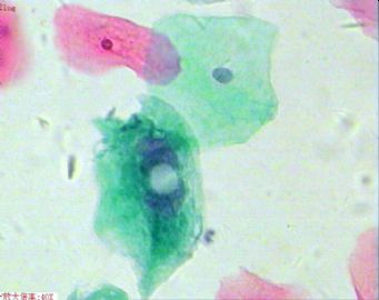 33岁，宫颈光滑，液基制片。图13