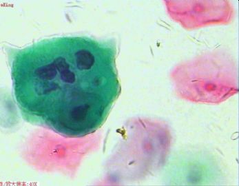 33岁，宫颈光滑，液基制片。图14