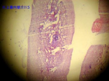 请老师会诊，右膝髌骨上方囊性肿物巨体很少见的病变图5