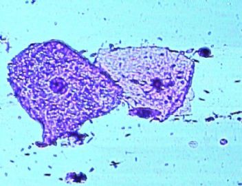 宫颈涂片里的怪东西图7