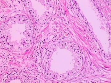 请问老师们，这个前列腺腺体有问题吗？（已确诊：前列腺增生症）图11