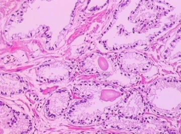 请问老师们，这个前列腺腺体有问题吗？（已确诊：前列腺增生症）图17