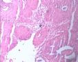 20080209宫颈LPT检查可见个别ASC-US细胞.46岁图1