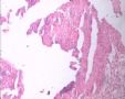 20080209宫颈LPT检查可见个别ASC-US细胞.46岁图5
