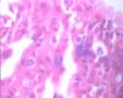 20080209宫颈LPT检查可见个别ASC-US细胞.46岁图8