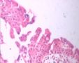 20080209宫颈LPT检查可见个别ASC-US细胞.46岁图9