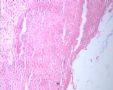 20080209宫颈LPT检查可见个别ASC-US细胞.46岁图11