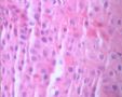 20080209宫颈LPT检查可见个别ASC-US细胞.46岁图13