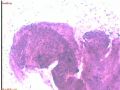 宫内膜病变术中印片--再传组织图片图1