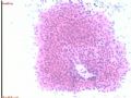 宫内膜病变术中印片--再传组织图片图5