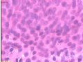 宫内膜病变术中印片--再传组织图片图6