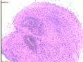 宫内膜病变术中印片--再传组织图片图8