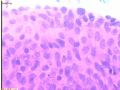 宫内膜病变术中印片--再传组织图片图9