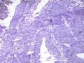 卵巢肿瘤(新传石蜡切片)图1