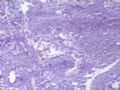 卵巢肿瘤(新传石蜡切片)图2