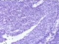 卵巢肿瘤(新传石蜡切片)图4