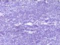 卵巢肿瘤(新传石蜡切片)图5