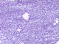 卵巢肿瘤(新传石蜡切片)图6