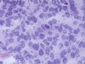卵巢肿瘤(新传石蜡切片)图9
