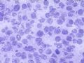 卵巢肿瘤(新传石蜡切片)图11