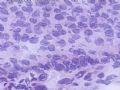 卵巢肿瘤(新传石蜡切片)图12