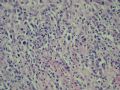 小肠肿物（会1301）-NK/T细胞淋巴瘤图6
