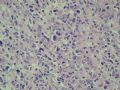 小肠肿物（会1301）-NK/T细胞淋巴瘤图8