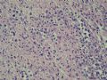 小肠肿物（会1301）-NK/T细胞淋巴瘤图9