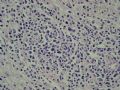 小肠肿物（会1301）-NK/T细胞淋巴瘤图10
