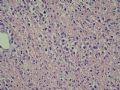 小肠肿物（会1301）-NK/T细胞淋巴瘤图11