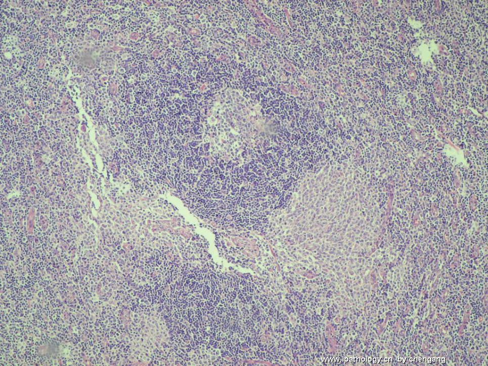 左颈淋巴结肿大（会1133）－单核样B细胞增生图2
