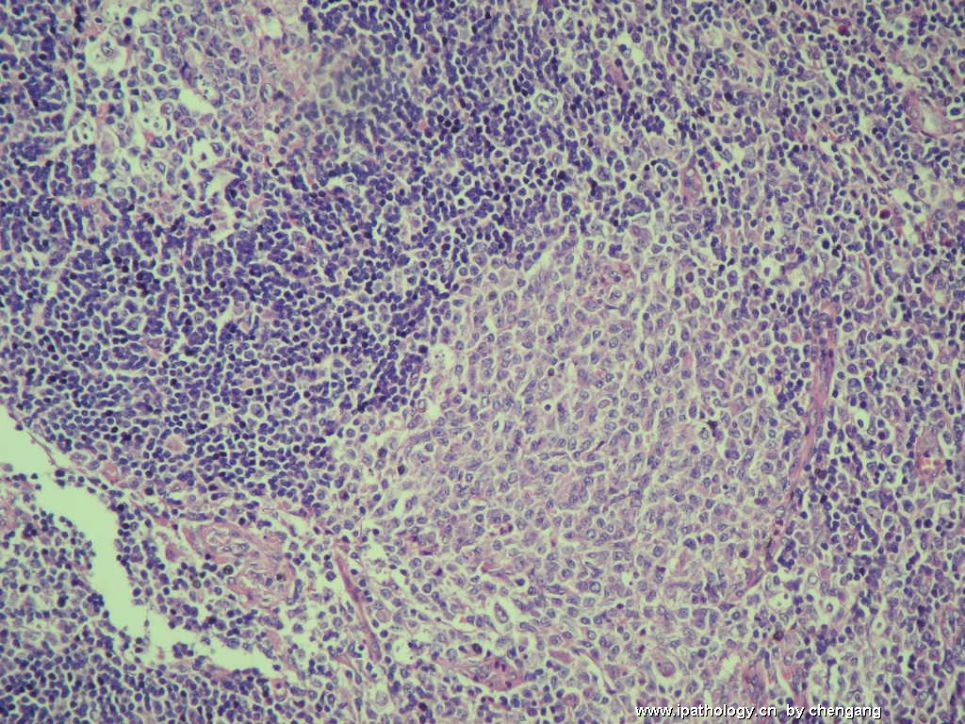 左颈淋巴结肿大（会1133）－单核样B细胞增生图3
