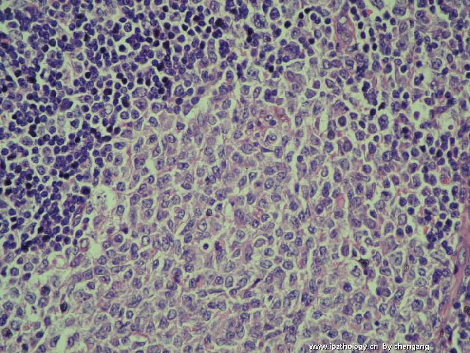 左颈淋巴结肿大（会1133）－单核样B细胞增生图4